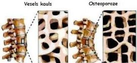 Latvijas pētnieku izstrādāta metode ļaus laikus noteikt osteoporozes risku pacientam
