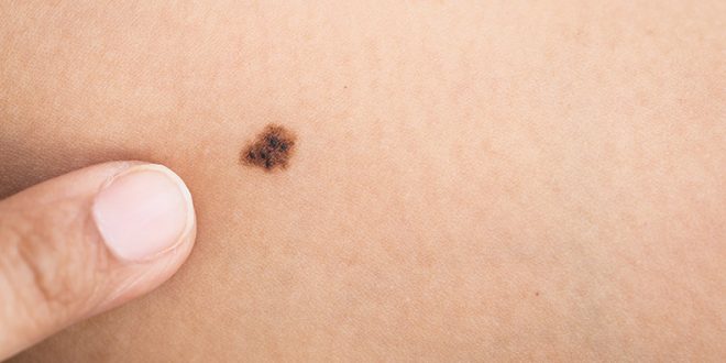 Rīgas 1.slimnīca aicina uz bezmaksas dzimumzīmju pārbaudēm