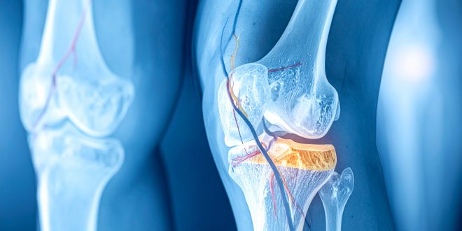 Uzmanīsim locītavas! Bursīts