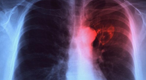 Latvijā ienāk jauni medikamenti tuberkulozes ārstēšanai
